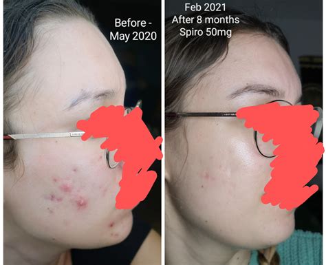 Spironolactone Progress Pics Acne And Hair Growth A Massive Thank You