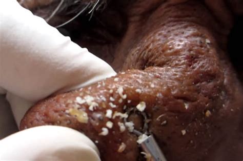 Blackheads And Whiteheads Squeezed From Nose In Sickening