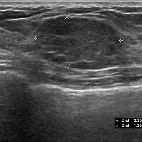 Initial Ultrasound Demonstrating The Left Breast Mass Measuring 24 ×