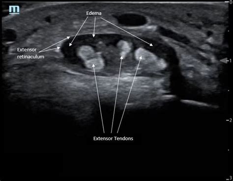 Point Of Care Ultrasound For The Diagnosis Of Extensor