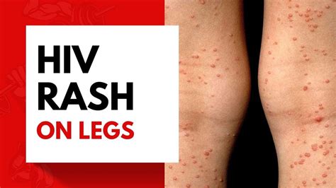 Hiv Rash On Legs Youtube