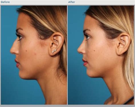 New And Totaly Optimized Non Surgical Nose Job In Boston Nose Job