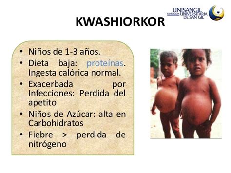 Kwashiorkor And Marasmus