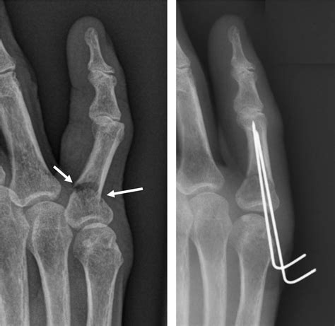Following the injury, the fingertip cannot be flexed (bent down) and the tendon can often be felt in the finger or the palm. Ring Xray Broken Finger