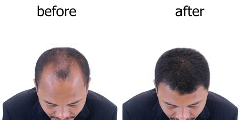What Is Male Pattern Baldness What Is Its Cure Pristyn Care