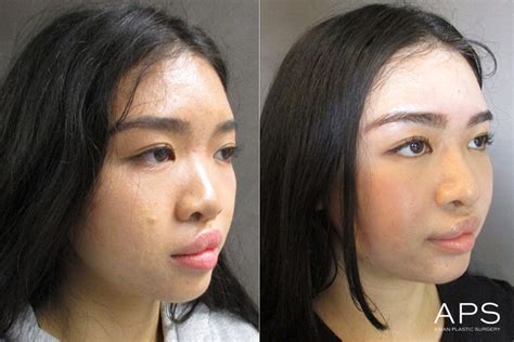 Rhinoplasty Before And After Photos For Asian Patients