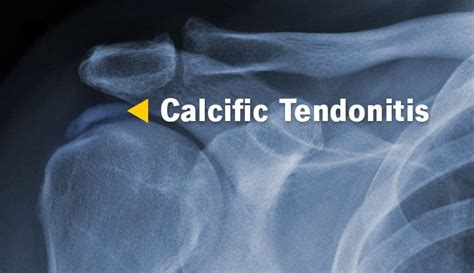 Calcific Tendonitis Of The Supraspinatus Tendon Radiology Case Hot Sex Picture