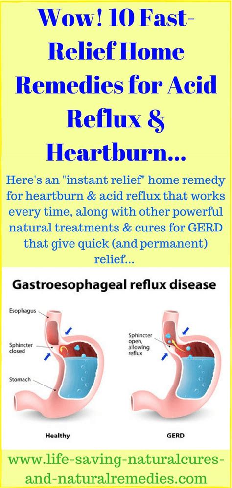Pin On Reduce Acid Reflux Naturally