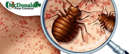 What Are The Signs Of A Bed Bug Allergic Reaction