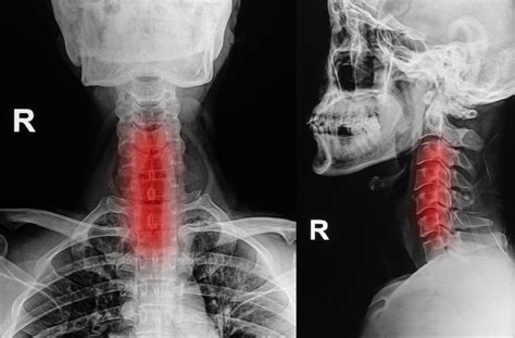 Flat Neck Syndrome Causes And Treatment