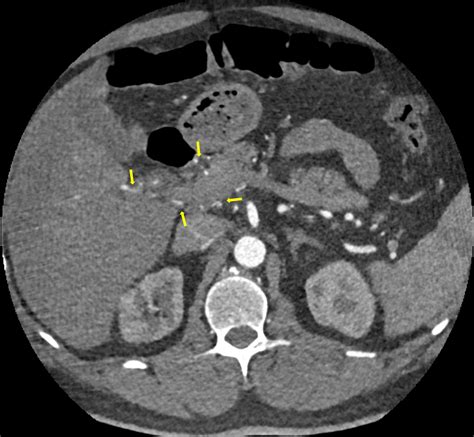 Cureus Abdominal Pain Caused By Occlusion Of The Celiac Trunk And