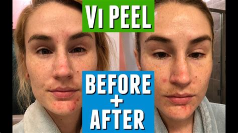 First Chemical Peel What To Expect Vi Peel Review Before After