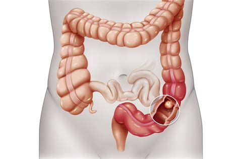 Obstruction within the small intestine (small bowel obstruction or sbo) is more common than a blockage elsewhere in the gastrointestinal tract. Intestinal Obstruction: Overview, Symptoms, Diagnosis, and ...