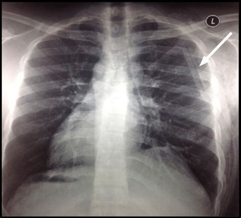 Chest X Ray Posteroanterior View Showing Re Expansion Of The Left