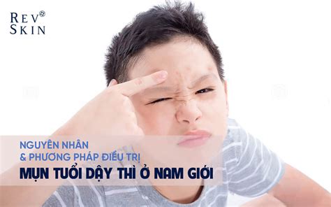 MỤn TuỔi DẬy ThÌ Ở Nam NguyÊn NhÂn VÀ CÁch ĐiỀu TrỊ