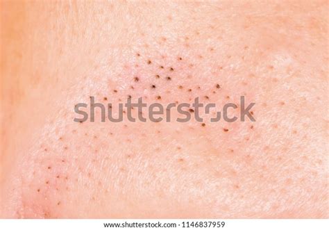 Blackheads On Skin Closeup Stock Photo Edit Now 1146837959
