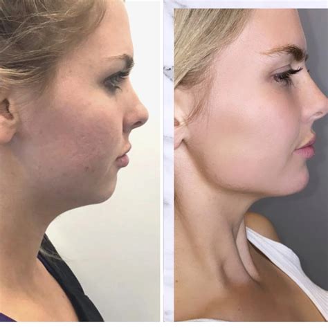 Chin Jawline Fillers In Gilbert Az Colair Med Spa