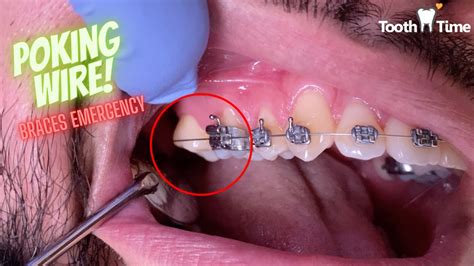 Braces Emergency What To Do If You Have A Poking Wire Tooth Time