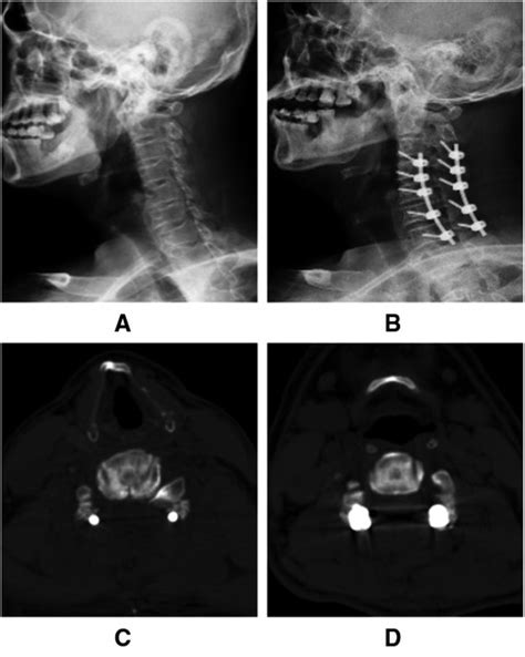 Evaluation Of Enlarged Laminectomy With Lateral Mass Screw Fixation In