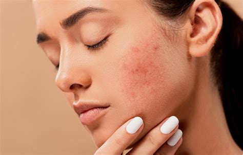 When To Seek Medical Help For Acne Pink Is The New Blog