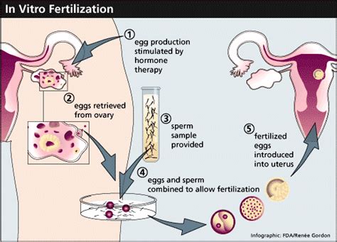 In Vitro Fertilization Ivf Process And Embryo Transfer Ivf Et