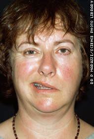 Bell's palsy can cause drooping or weakness on one side of your face. sikkahoder: Penyebab dan cara mengobati wajah lumpuh ...