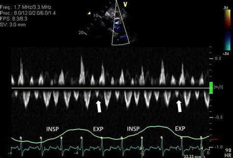 Spectral Doppler Imaging Of Hepatic Venous Flow By Echocardiography