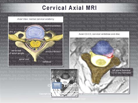 Cervical Axial Mri Trialexhibits Inc