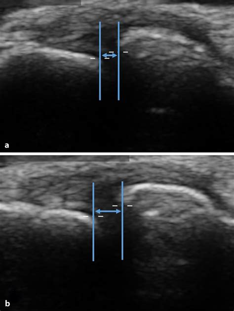 8 Sonographic Evaluation Of The Lateral Elbowa Unstressed B With