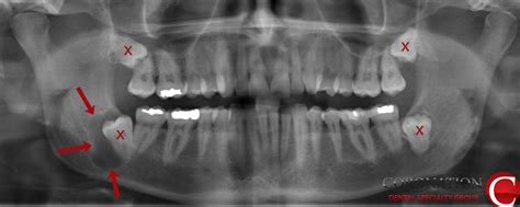 Oral And Maxillofacial Surgery Removal Of Impacted Wisdom Teeth