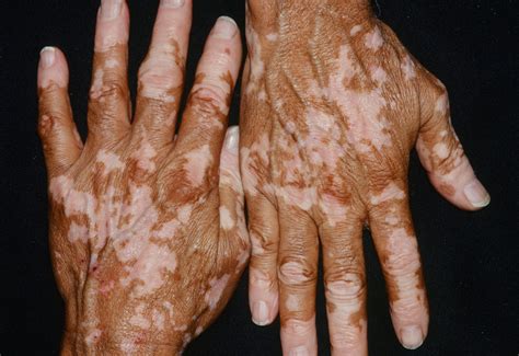 Vitiligo Causes Symptoms Vitiligo Skin Disease Treatment
