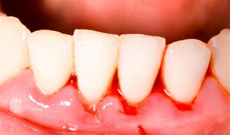Bleeding Of Gums Caused Due To Vitamin Deficiency