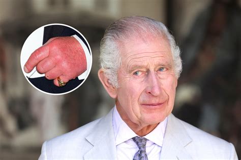 Everything King Charles Said About His Famous Sausage Fingers