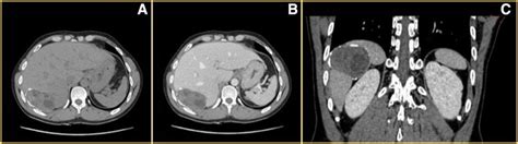 Presence Of Daughter Cysts On Ct Imaging In A Hydatid Cyst Of The Vii