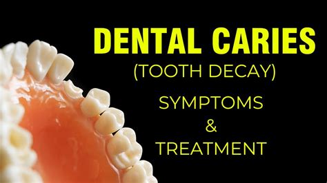 Dental Caries Tooth Decay Symptoms Treatment Dental Clinic