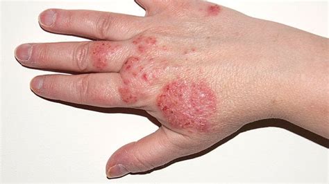 The Difference Between Scabies And Eczema Flash Uganda Media