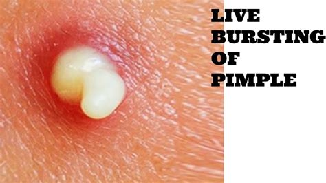 Live Bursting Of A Big Pimple With Loads Of Pus 9th Daily Vlogs