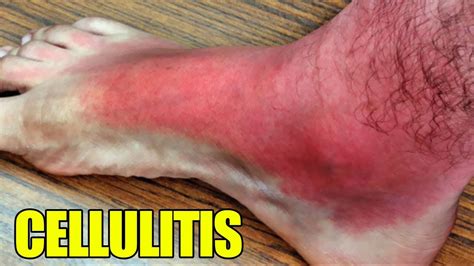 Cellulitis Treatment Symptoms And Causes