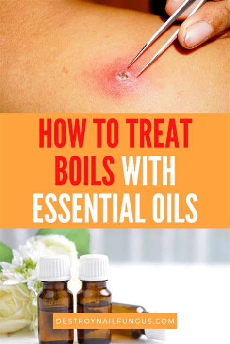 Your Natural Remedies Guide 5 Best Essential Oils For Boils