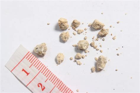 Kidney Stone Size Chart In Mm And Cm Millimeter And Centimeter