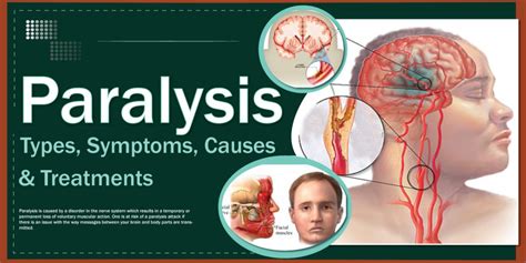 Paralysis Types Symptoms Causes And Treatments
