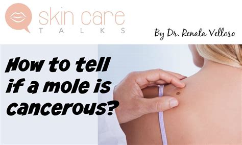 Cancerours Moles How To Tell If A Mole Is Cancerours Youtube