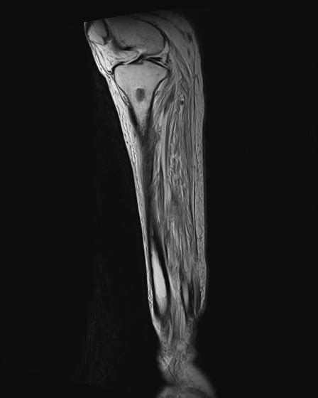 Chronic Osteomyelitis Tibia With Sequestrum Image