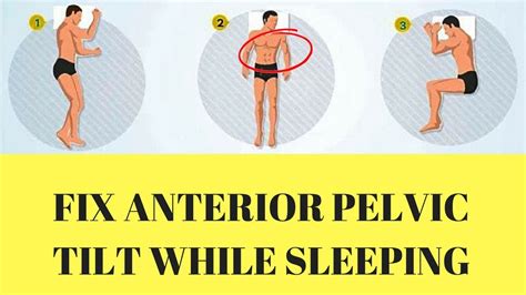 How To Fix Anterior Pelvic Tilt While Sleeping Youtube