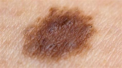 Skin Cancer Check Number Of Moles On Your Right Arm An Indicator Of Risk Experts Say Herald Sun
