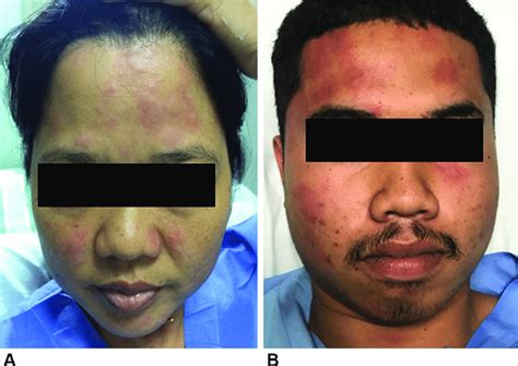 Isolated Facial Urticaria Observed During The Challenge In Patients