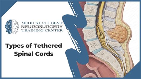 Types Of Tethered Spinal Cords Youtube
