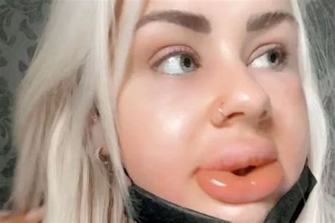 Beauty Lover Left With Giant Sausage Lips After Horror Reaction Sees