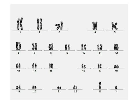 A Normal Karyotype Frequently Obtained For The Pws Patients A More