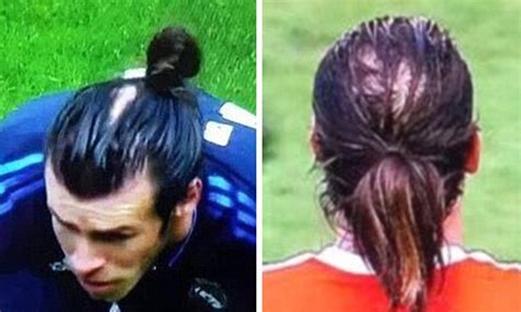 Gareth Bale To Receive A Hair Transplant Daily Mail Online